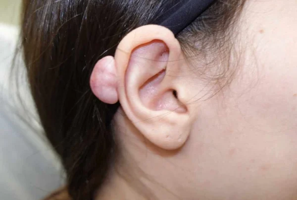 Ear keloid that developed after an ear piercing
