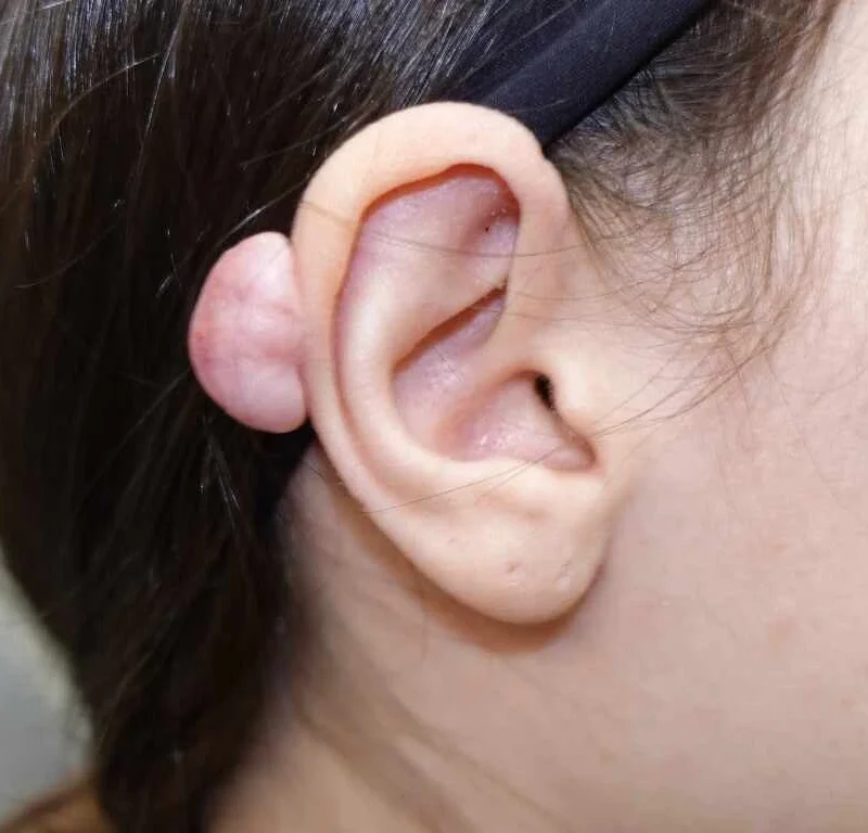 Ear keloid that developed after an ear piercing