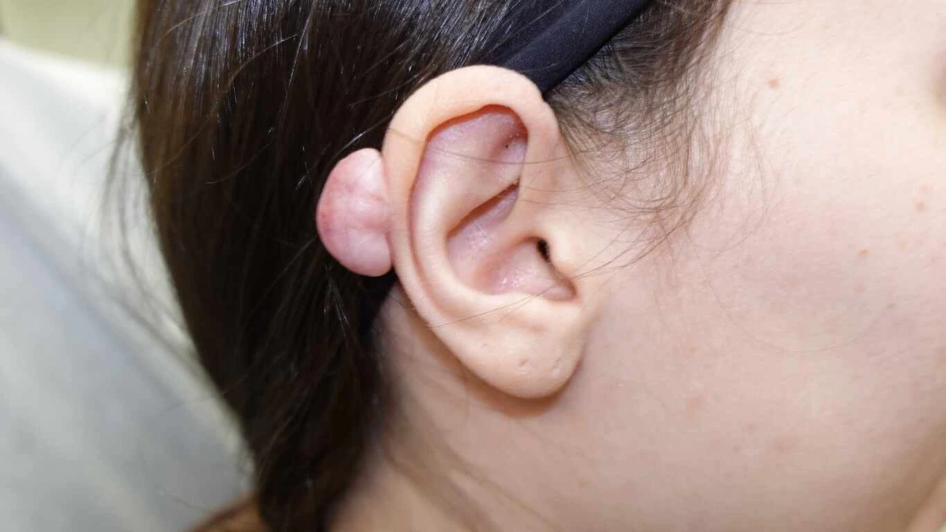 Ear keloid that developed after an ear piercing