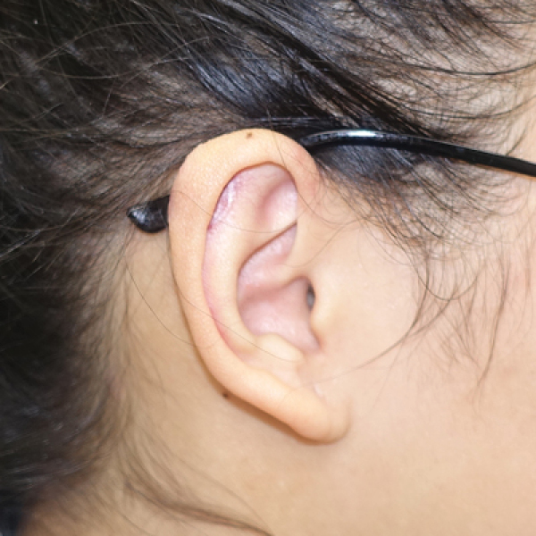 earlobe keloid removal