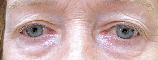 Before blepharoplasty front view