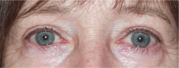 After blepharoplasty front view