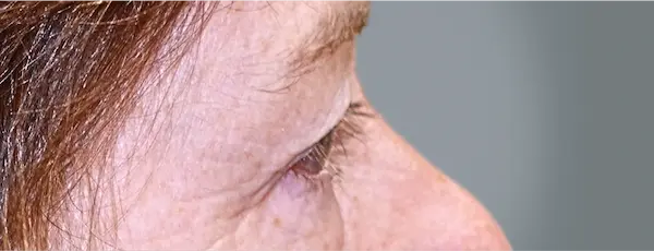 Before blepharoplasty left side view