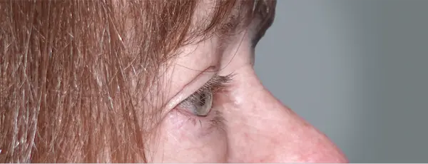 After blepharoplasty left side view