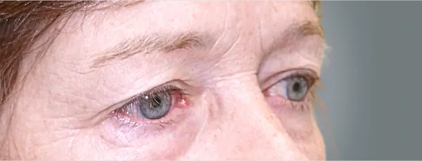 Before blepharoplasty left oblique view