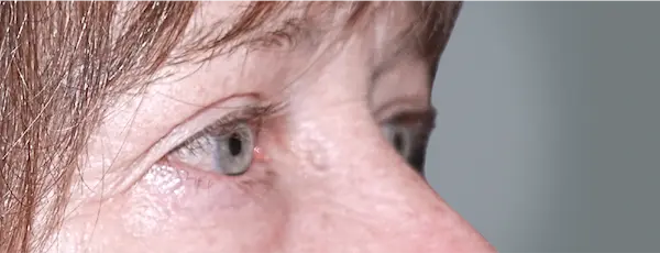 After blepharoplasty left oblique view