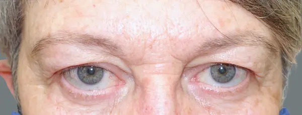 Before blepharoplasty front view