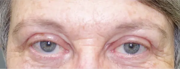 After blepharoplasty front view