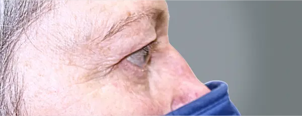 Before blepharoplasty front view