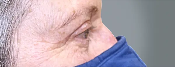 After blepharoplasty front view