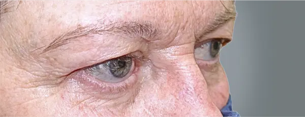 Before blepharoplasty left oblique view
