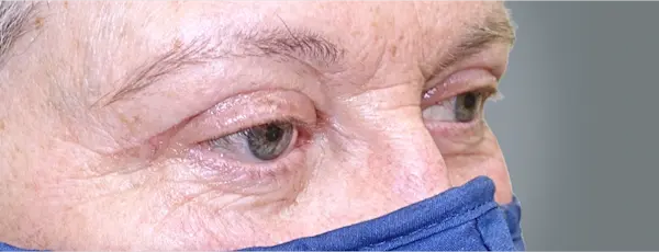 After blepharoplasty left oblique view