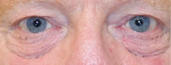 Before blepharoplasty front view