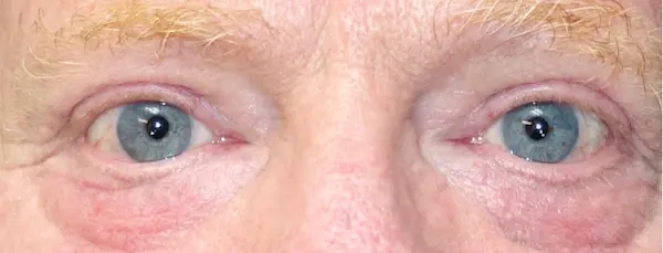 After blepharoplasty front view
