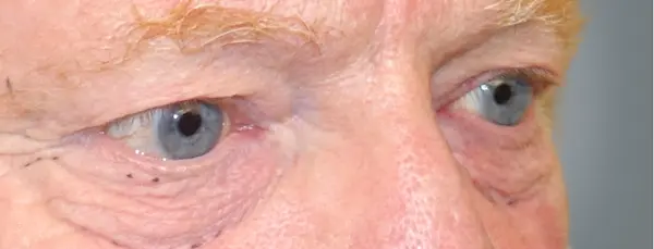 Before blepharoplasty left oblique view