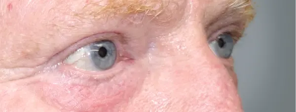 After blepharoplasty left oblique view