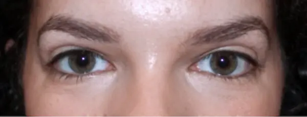 After Blepharoplasty front view