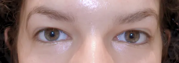 Before Blepharoplasty front view