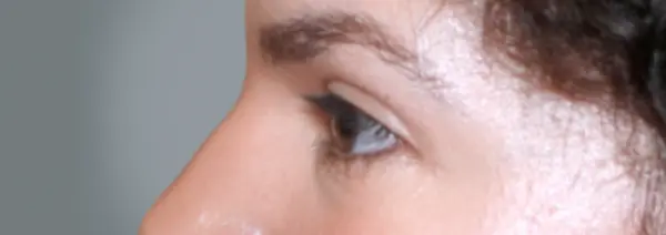 After Blepharoplasty right side view