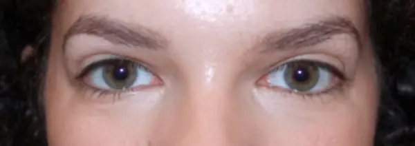 After Blepharoplasty front view