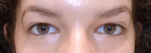 Before Blepharoplasty front view