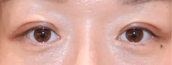 After blepharoplasty front view