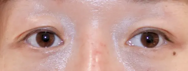 Before blepharoplasty front view