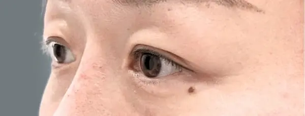 Before blepharoplasty right oblique view