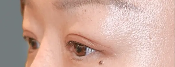 After blepharoplasty right oblique view