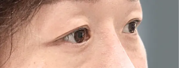Before blepharoplasty left oblique view