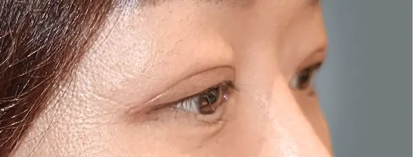 After blepharoplasty left oblique view