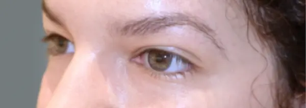 Before Blepharoplasty right oblique view