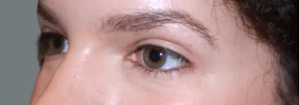 After Blepharoplasty right oblique view