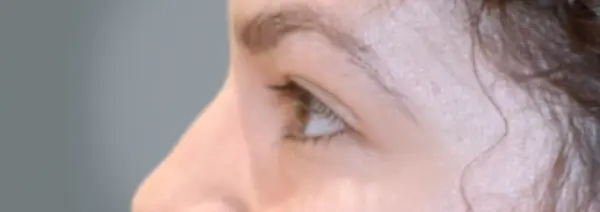 Before Blepharoplasty right side view