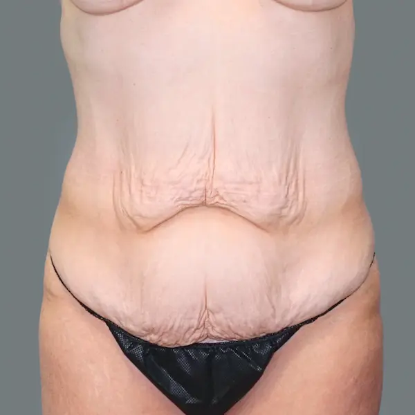 Before abdominoplasty front view