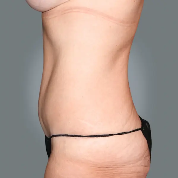 After abdominoplasty right side view