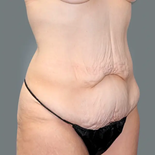 Before abdominoplasty left oblique view
