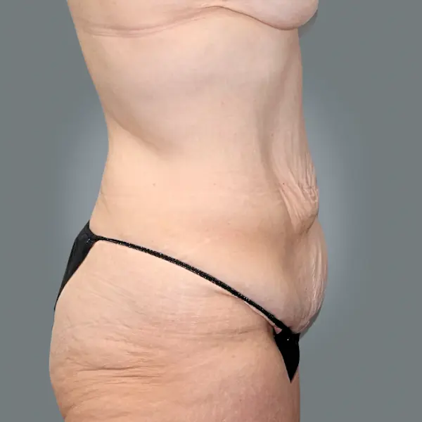 Before abdominoplasty left side view