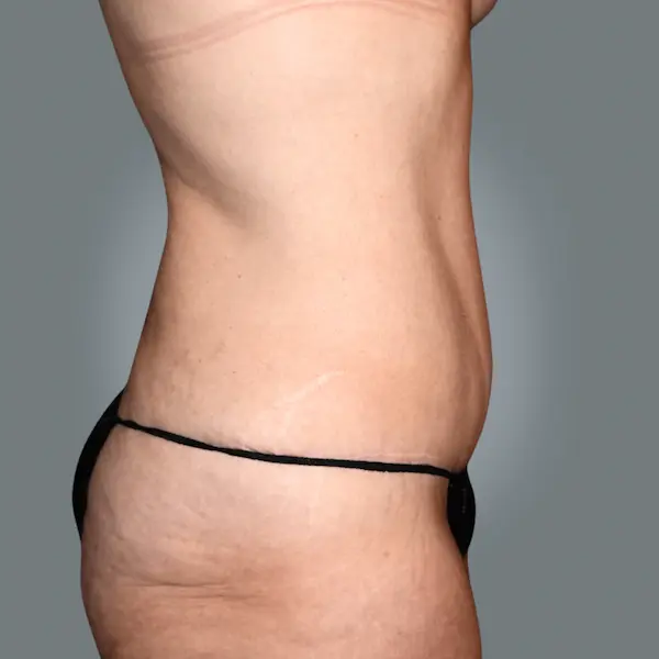 After abdominoplasty left side view
