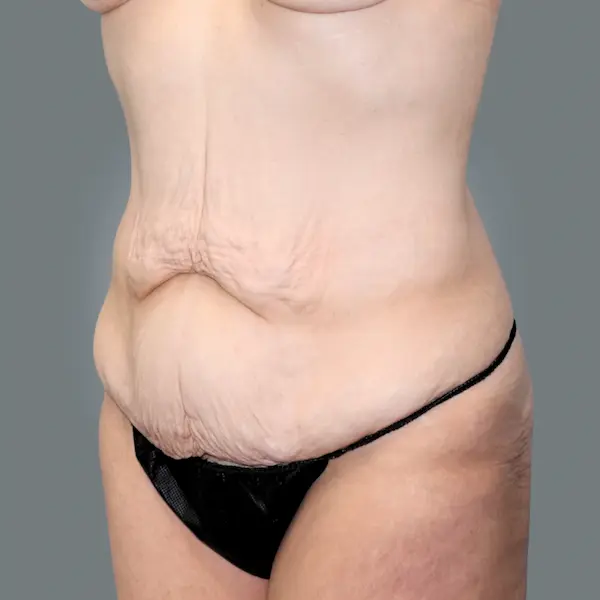 Before abdominoplasty right oblique view
