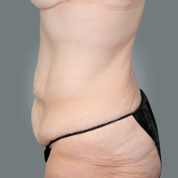 Before abdominoplasty right side view