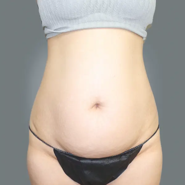 Before abdominoplasty front view