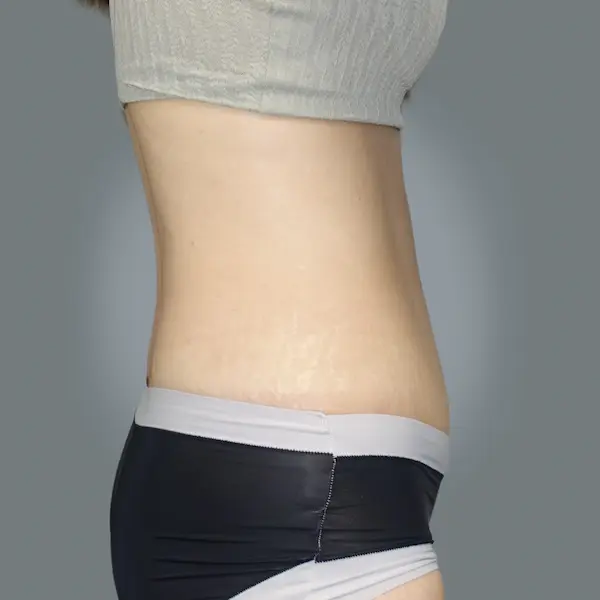 After abdominoplasty left side view