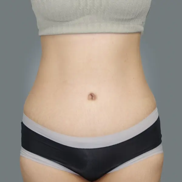 After abdominoplasty front view