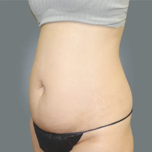 Before abdominoplasty right oblique view