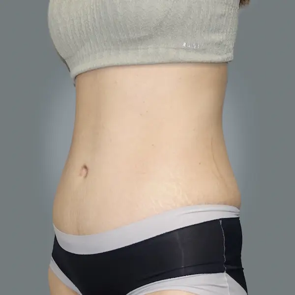 After abdominoplasty right oblique view