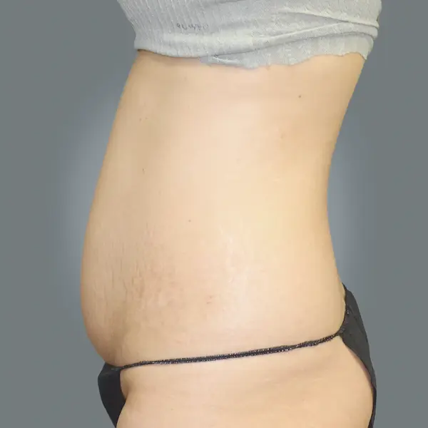 Before abdominoplasty right side view