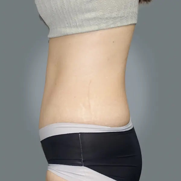 After abdominoplasty right side view