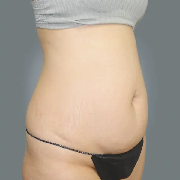 Before abdominoplasty left oblique view