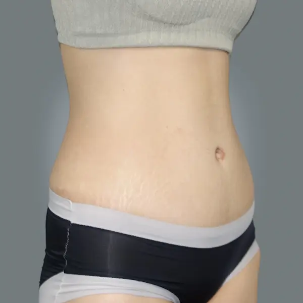 After abdominoplasty left oblique view